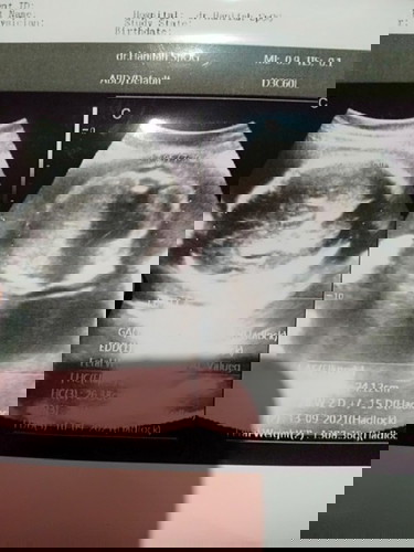 bun aku kan hamil 7 bulan kemarin di usg tapi kenapa jenis kelamin nya gak keliat ya?
apakah normal?