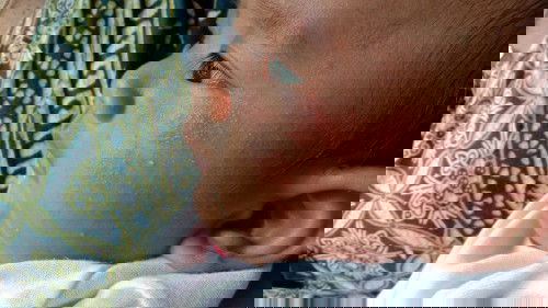 Merah merah dikulit pipi