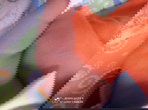 Seputar bayi bintik2 merah