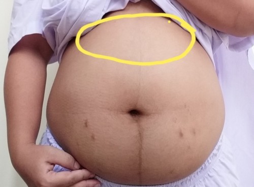 แน่นจุกตรงลิ้นปี่ เพลีย เหนื่อยง่าย