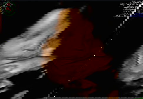 Membaca hasil USG 4D