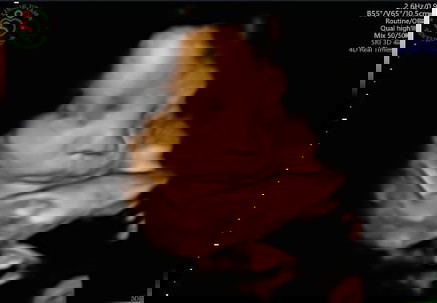 Membaca hasil USG 4D