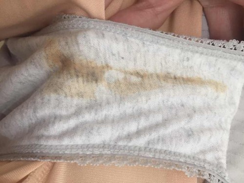 ตกขาวหรือมีเลือด