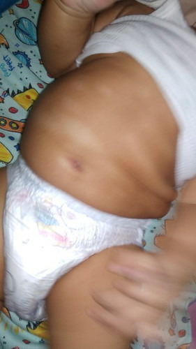 hilangin ruam kyk gini, pake sebamed apa mustela yaa? sblmnya pake johnsson,switszal