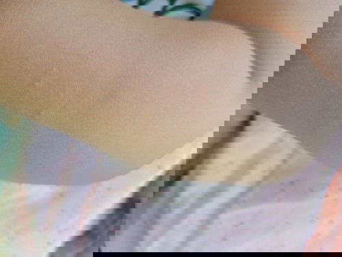 Anak saya bruntusan putih