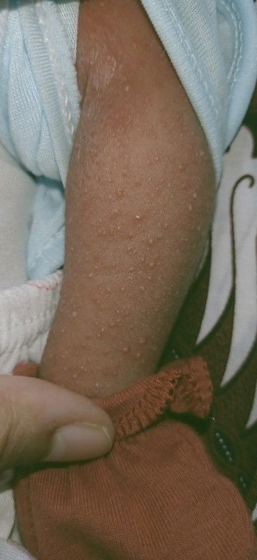 Bintik merah campur nanah