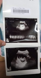 ได้เห็นเด็กน้อยดิ้นตอนยุในท้องรุ้สึกดีใจมากมีโบกมือให้คุนหมอให้ความร่วมมือมากลูก11week3day