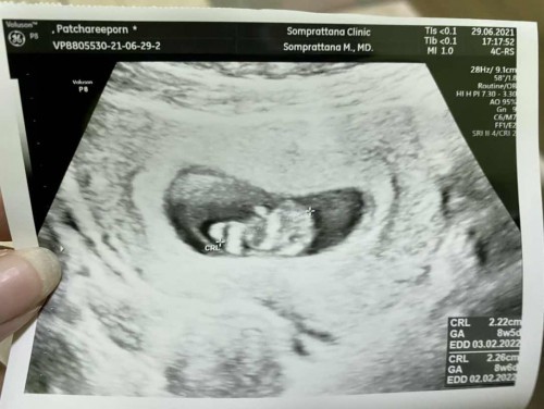 นับอายุครรภ์ได้11w3d แต่ในใบซาวเป็น8w6d เป็นเพราะอะไรคะ ท้องแรกค่ะ