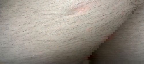 ตุ่มน้ำใสๆคันมสก พอแตกแล้วแสบสุดๆ