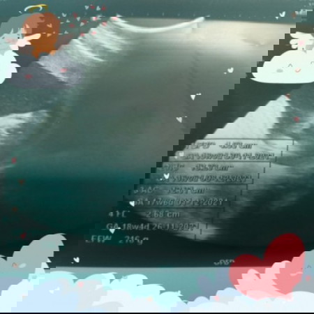 แม่ๆว่าจะได้ลูกสาวหรือลูกชายคะ 17w+2 d