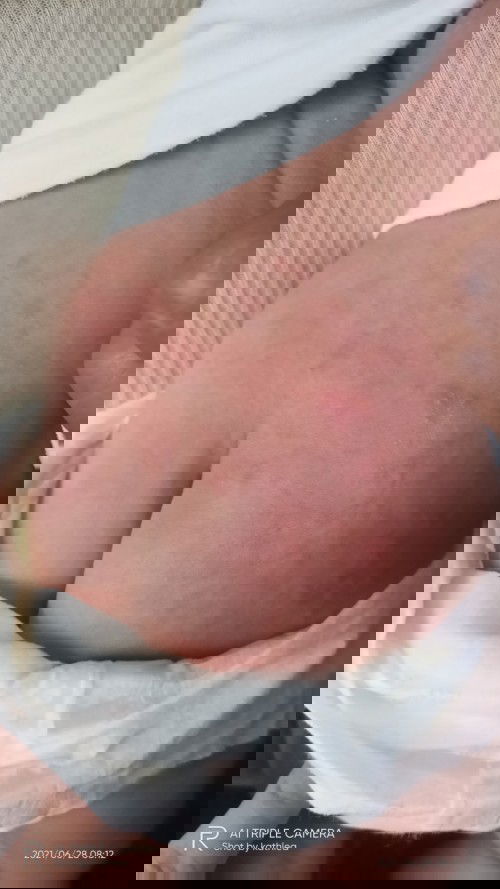 RASHES PO BA ITO OR WHAT?