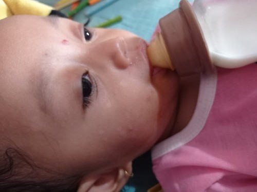 Bercak putih di pipi