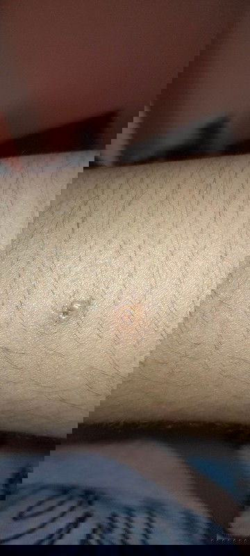 อีสุกอีใสขณะตั้งครรภ์‼️