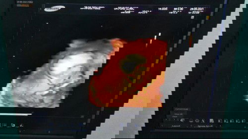 อัลตราซาวด์ ตอนอายุครรภ์ 18 สัปดาห์ น้องเป็น ผู้หญิงค่ะ