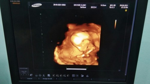 อัลตราซาวด์ ตอนอายุครรภ์ 18 สัปดาห์ น้องเป็น ผู้หญิงค่ะ