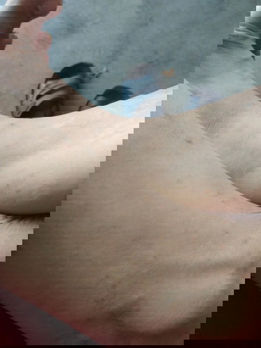 Mấy m có cách nào trị sẹo lâu năm chỉ e với ạ