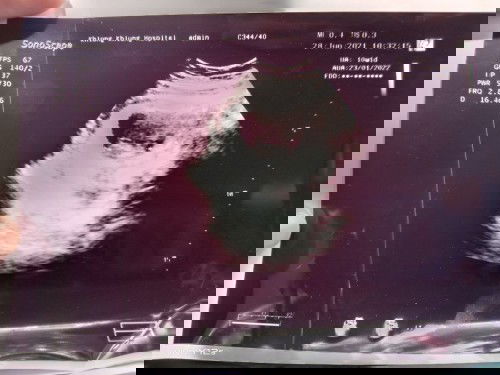 10+1week
ท้องแรกค่ะ 10+1week 
สอบถามแม่ๆค่ะน้องตัวเล็กไปไหมคะ? ไปหาคุณหมอรอบนี้ไม่ได้บอกอะไรเลยค่ะ