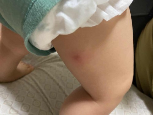 Baby skin boil on baby feet