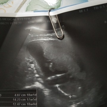 ตั้งครรภ์17วิค ไปอัลตร้าชาวด์มาอยากรู้ว่าลูกอยู่ตรงไหนค่ะ หมอไม่อธิบายให้ฟังค่ะ ขอบคุณค่ะ