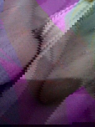 Titik2 kecil merah dan bernanah disekujur tubuh