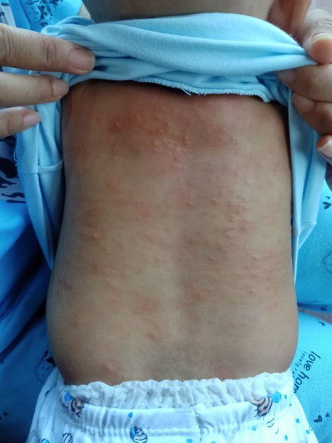 Bintik bintik d punggung