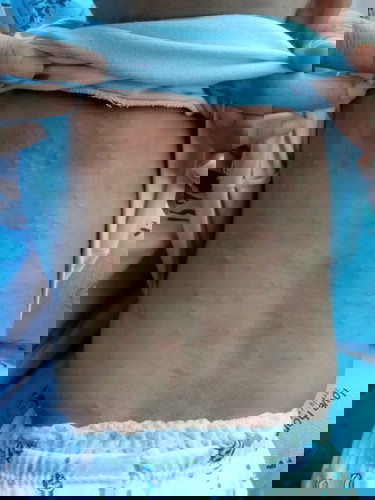 Bintik bintik d punggung