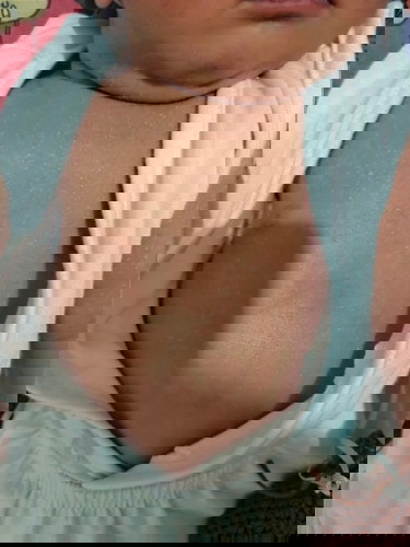 hello po! ano po pangalan ng rashes na ito? at ano po pwede igamot? marami po tumubo sa kanya