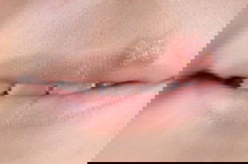 #แม่บ้านไหนเป็นโรคเริมบ้างคะ