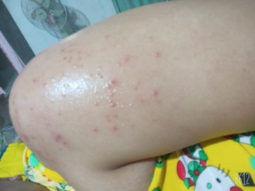 E vừa sanh xong trời nóng quá nổi như này.có cách nào hết kh ạ