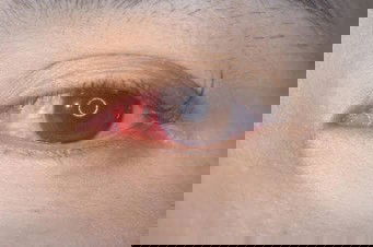 Mata merah pada bayi umur 1 tahun