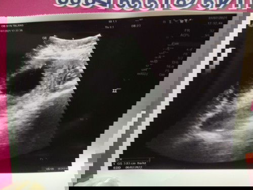 12วีค ไม่พบตัวอ่อน