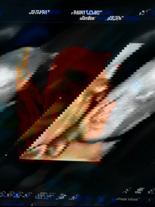 สายสะดือพาดคอน้อง แม่เครียดจังค่ะ แม่ๆท่านอื่นใครเคยเป็นมั้ยคะ แล้วแม่ๆมีวิธียังไงบ้าง 25+5w