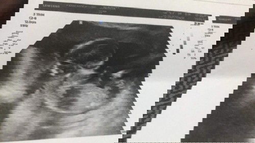 น้อง 15+3week น้ำหนัก 111g ถือว่าเยอะไปไหมค่ะ