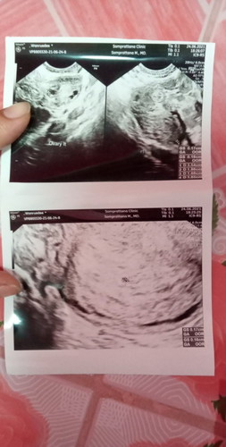 ในใบซาวถุงตั้งครรภ์หนูเล็กมากๆเลยคะ
กลัวท้องลมมากกังวลไปหมดเลย...มีใครถุงเล็กมากขนาดนี้ไหมคะซาวตอน5w