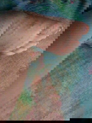 Seluruh badan ada brintil merah