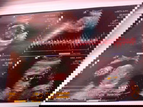 Berapa minggu ini bunda?
Mana yg tepat nya bunda?