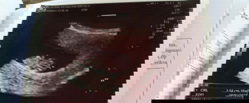 Syukur.  10 weeks suda jelas ☺️.