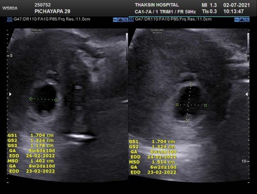 9 week ไปซาวด์ครั้งแรก เจอแต่ถุงตั้งครรภ์ และไข่แดง