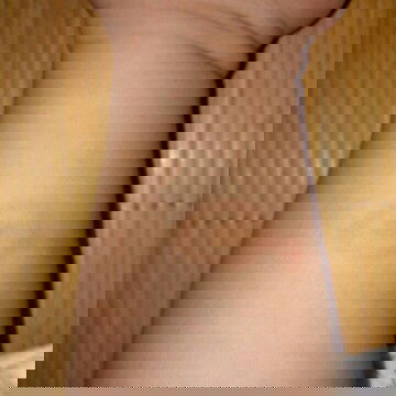 Bé mình bị nốt như này là bị sao hả các mom?