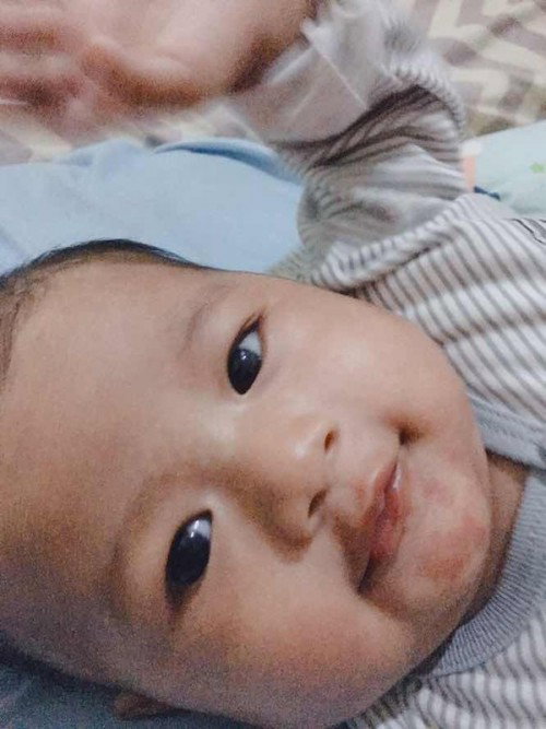 Flek putih di wajah seperti panu