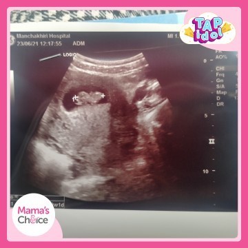 คุณแม่บ้านไหนทีมเดือนมกราคม 65 บ้างค่ะ กำหนดคลอดวันไหนบ้าง