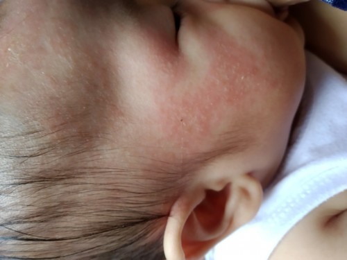 Rashes sa mukha ni baby