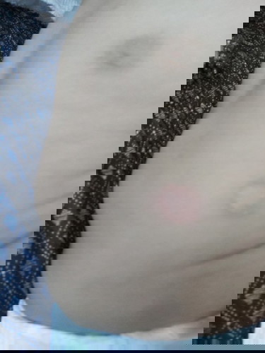 Is this ringworm?
