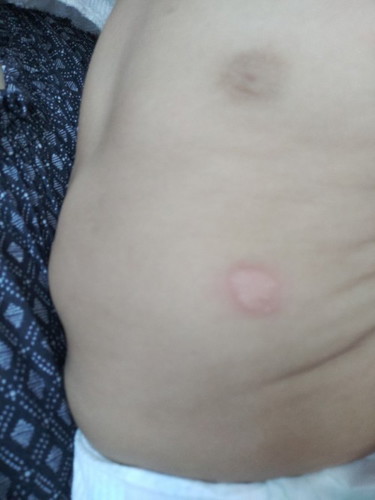 Is this ringworm?