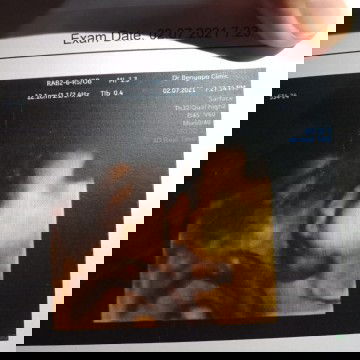 อัลตราซาวด์4มิติ