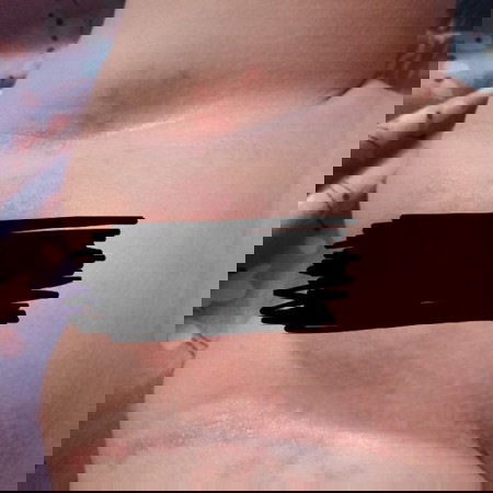 rashes