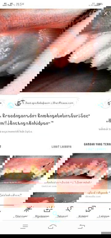 Gusi bengkak saat hamil