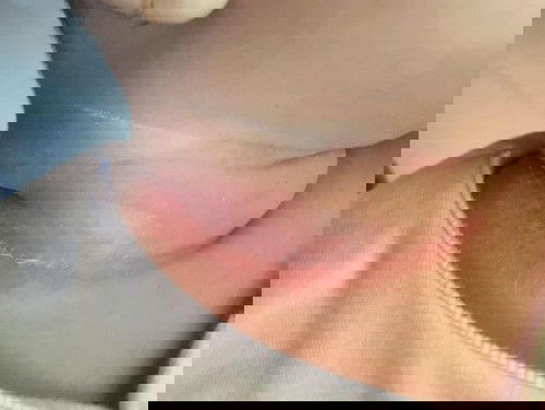 Ruam merah melingkar dileher