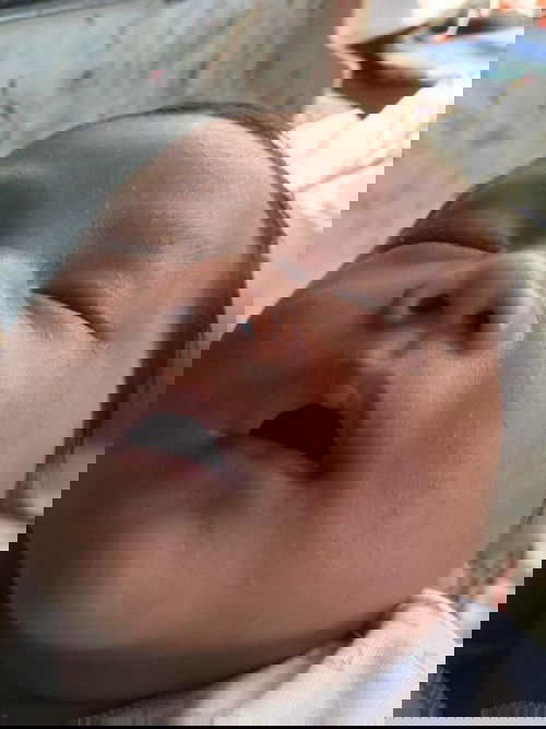 Biang keringat atau saraf?