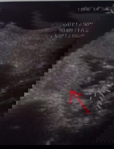 ภาพอัลตร้าซาวด์ตอน3เดือนครึ่ง คุณหมอบอกน่าจะเป็น ผช แต่ไม่ฟันธงเพราะถ้าไห้แน่ใจต้อง4เดือนขึ้นไป